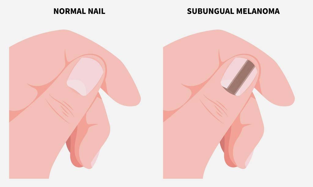 Fingernail 